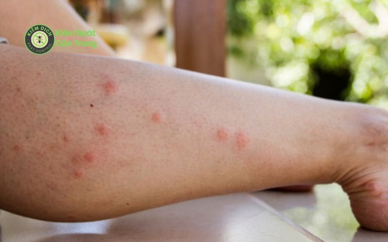 Bị muỗi đốt có nên bôi dầu gió không? 5 Cách đuổi muỗi tốt Muỗi đọt sưng to